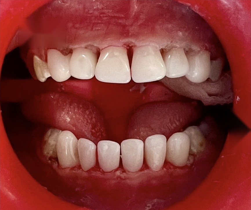 After treatment: decay on upper and lower teeth restored