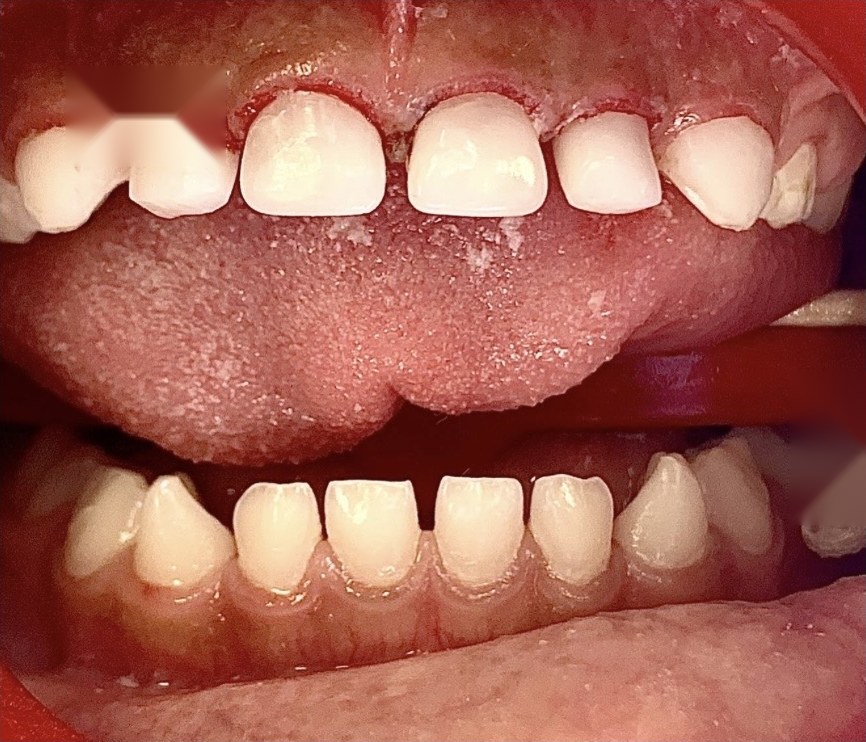 After treatment: severely decayed front teeth restored